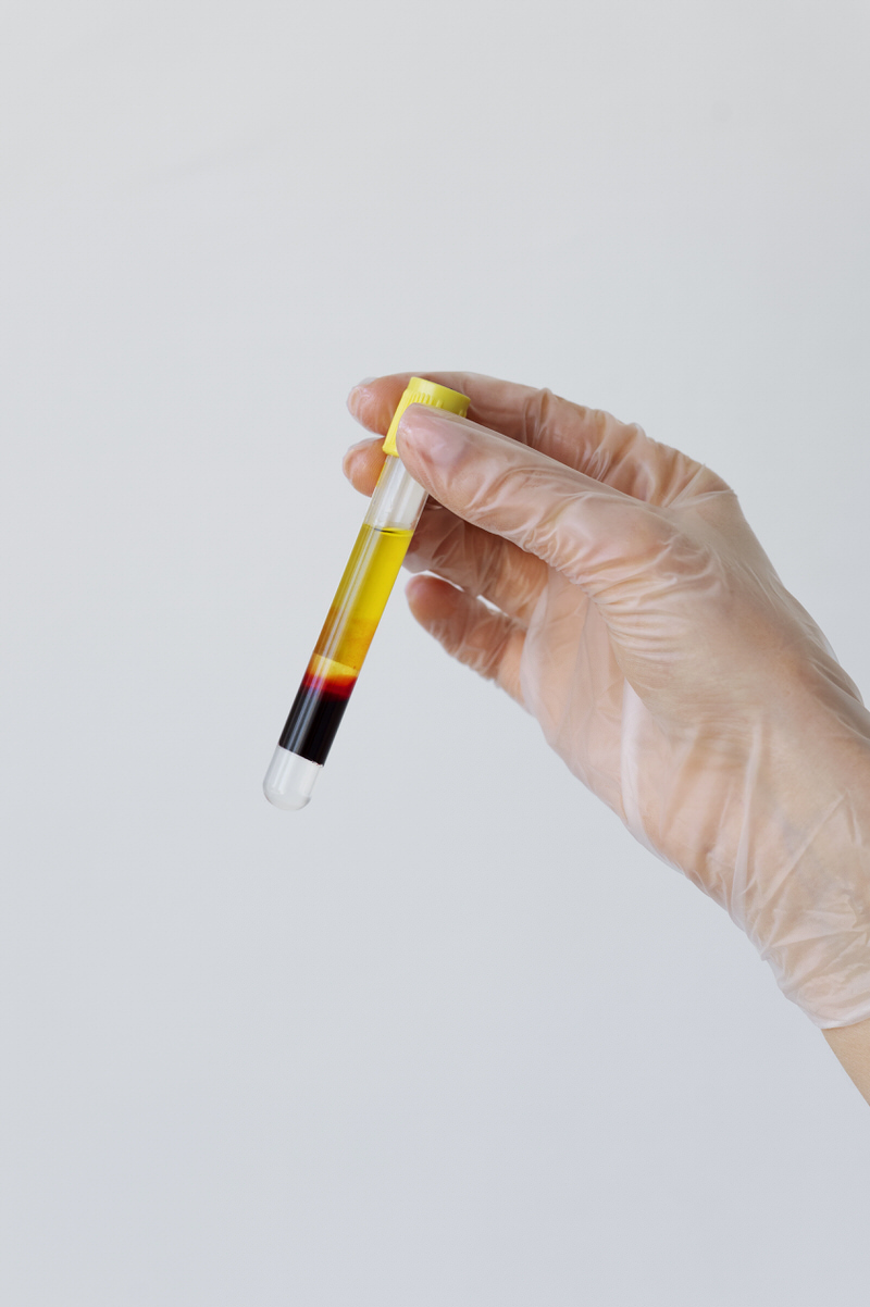 Prp Platelet Rich Plasma The White Clinic